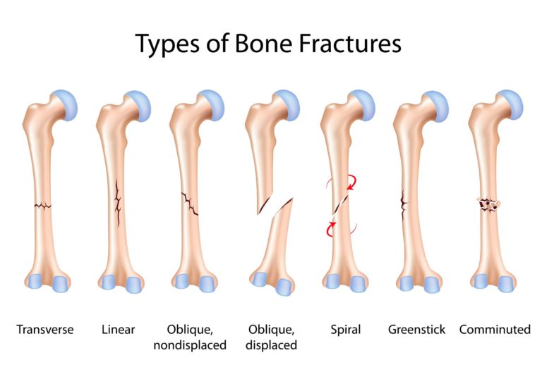 types-of-broken-bones-symptoms-treatment-healing-hernando