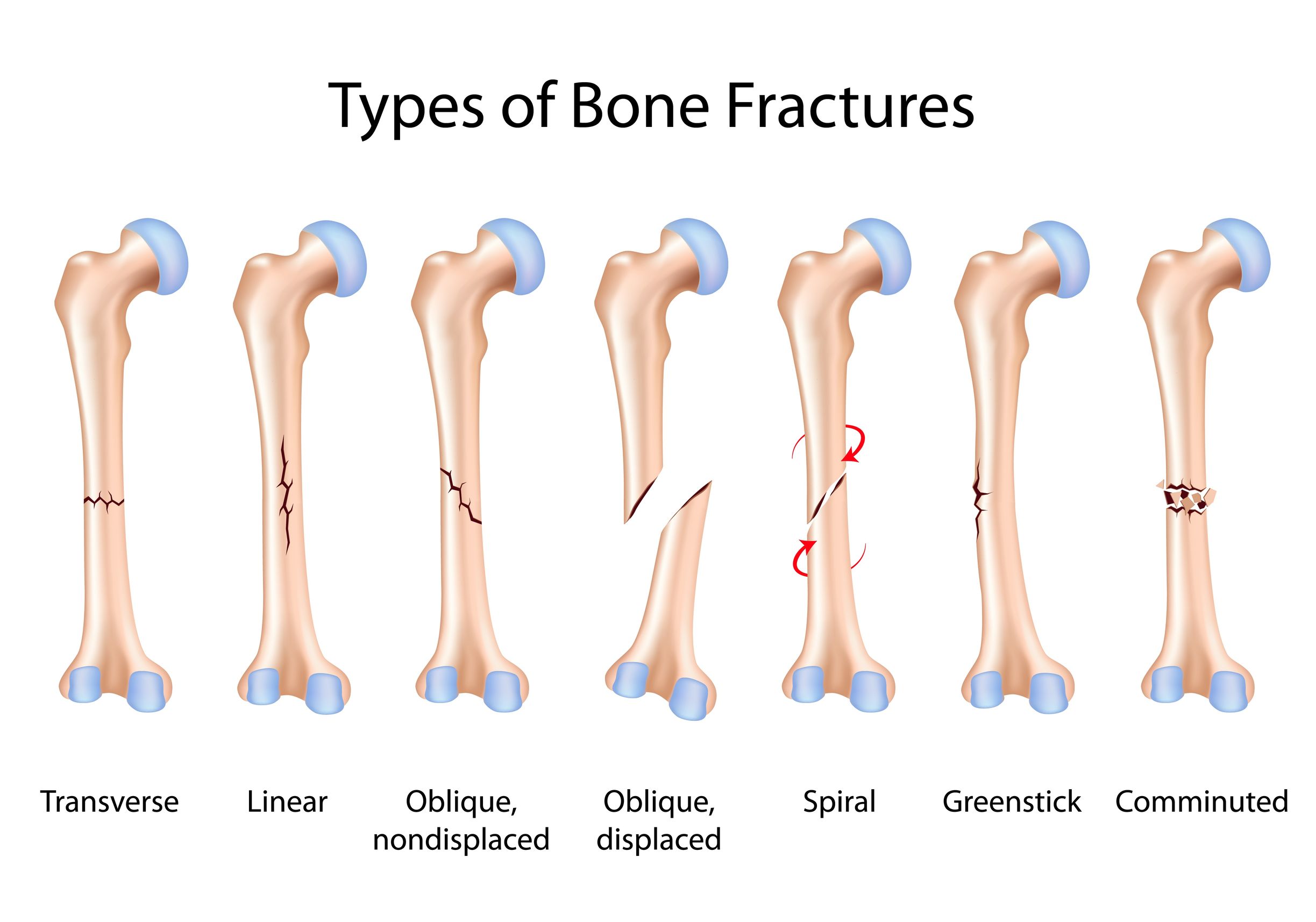 Types Of Fractures Worksheet