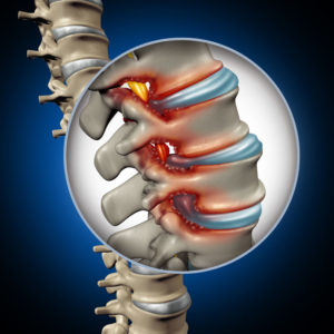 Can Spinal Stenosis Be Reversed? - Hernando Orthopedic & Spinal Surgery ...